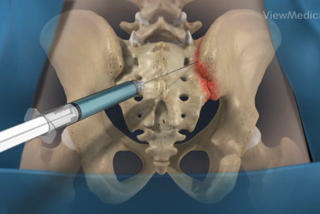 Sacroiliac Injection (SI)